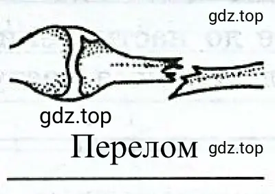 Рисунок 5. Перелом кости