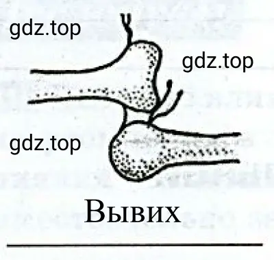 Рисунок 6. Вывих суставов