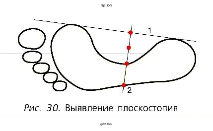 Рис. 30. Выявление плоскостопия