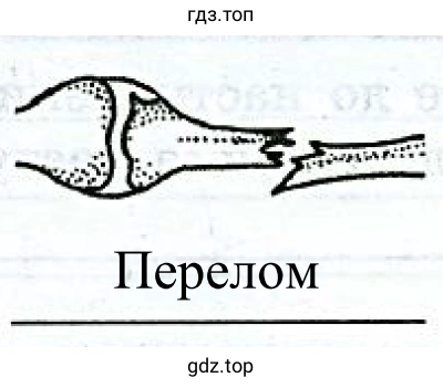 Рисунок 5. Перелом кости