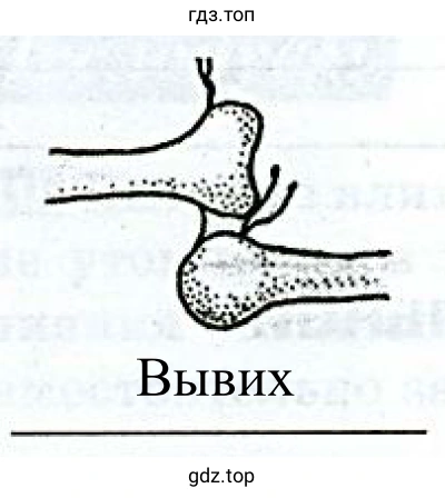 Рисунок 6. Вывих суставов